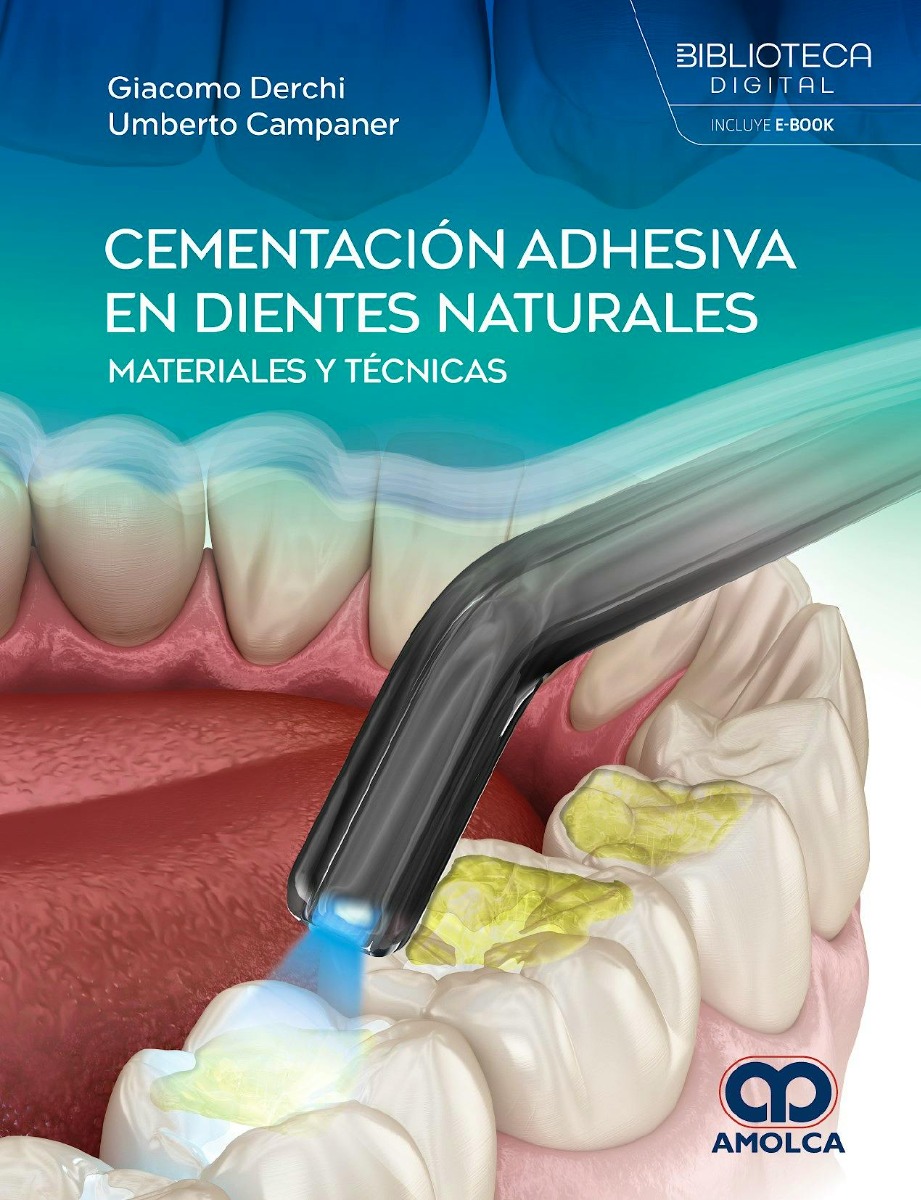 Cementación Adhesiva en Dientes Naturales