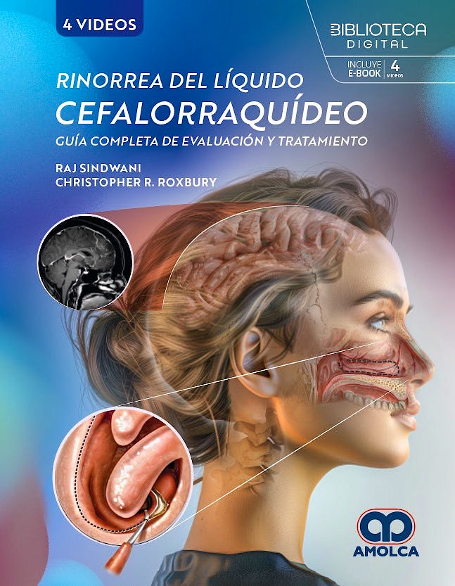 Rinorrea del Líquido Cefalorraquídeo