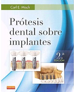 Prótesis dental sobre implantes .