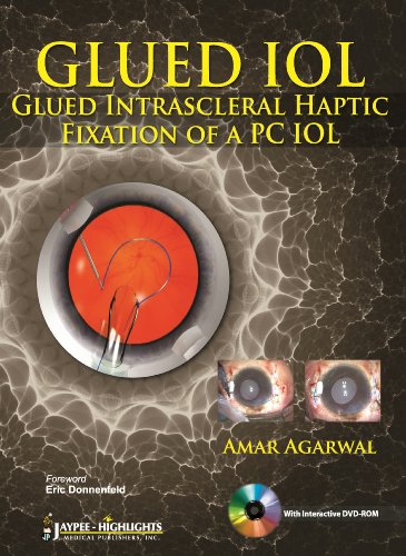 GLUED IOL: Glued Intrascleral Haptic Fixation of a PC IOL