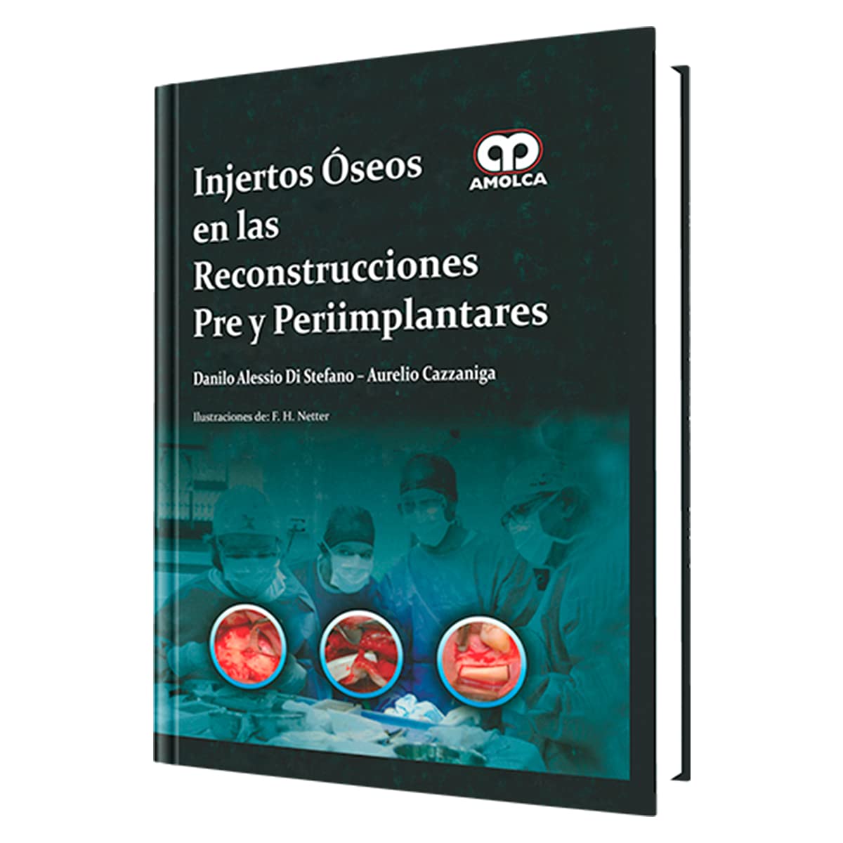 Injertos Óseos en las Reconstrucciones Pre y Periimplantares