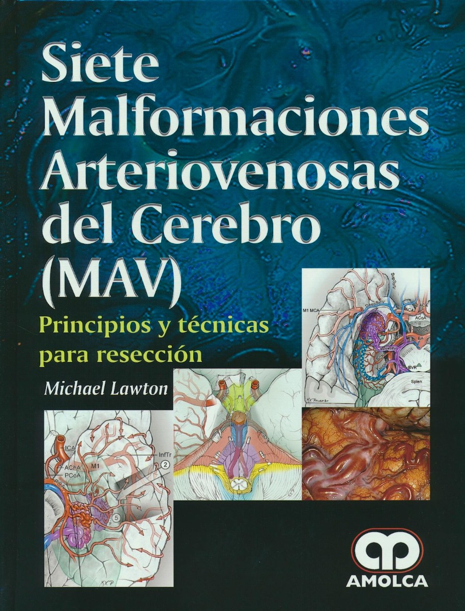 Siete Malformaciones Arteriovenosas del Cerebro (MAV)