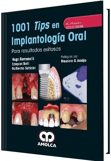 1001 Tips en Implantología Oral