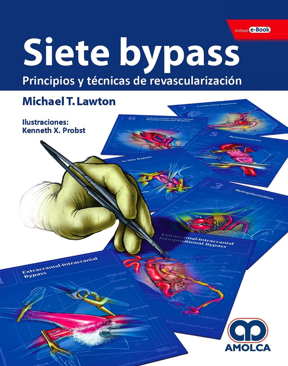 Siete Bypass Principios y Técnicas de Revascularización