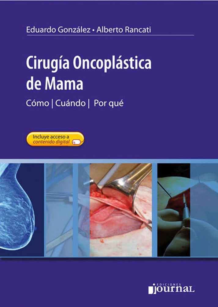 Cirugía Oncoplástica de Mama. Cómo, Cuándo, Por qué
