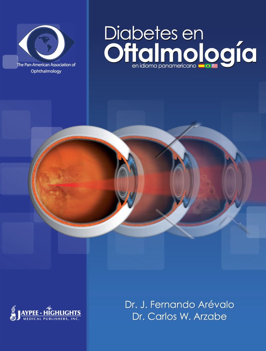Diabetes en Oftalmologia