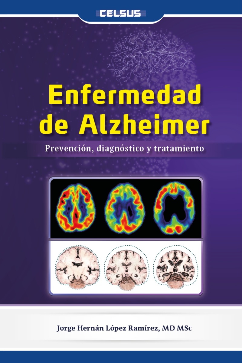 Enfermedad de Alzheimer