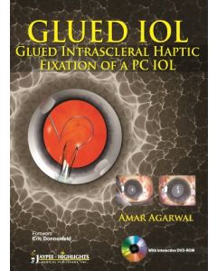 GLUED IOL: Glued Intrascleral Haptic Fixation of a PC IOL