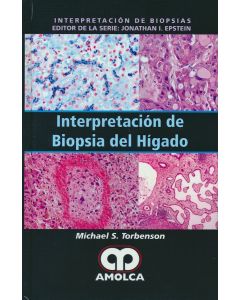 Interpretación de Biopsia del Hígado