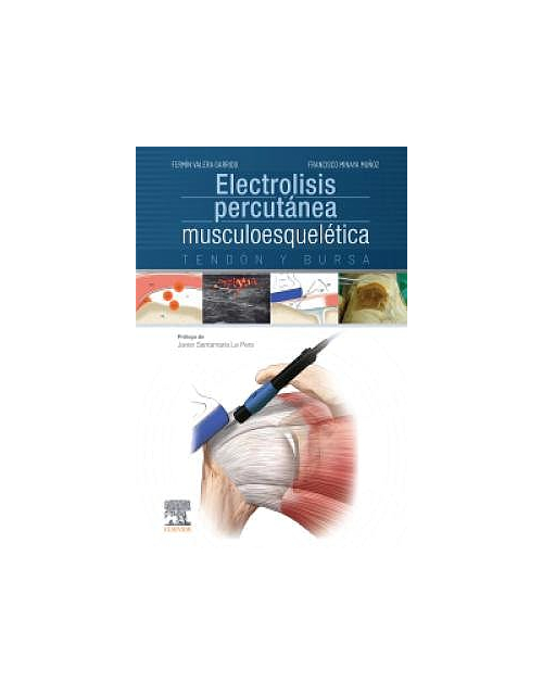 Electrolisis Percutánea Musculoesquelética. Tendón Y Bursa