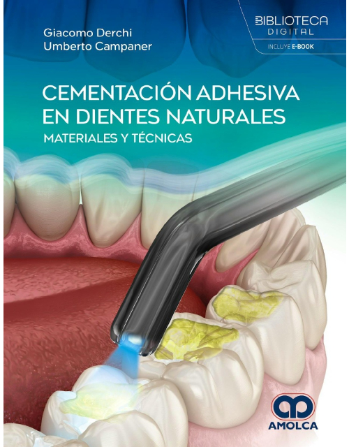 Cementación Adhesiva en Dientes Naturales