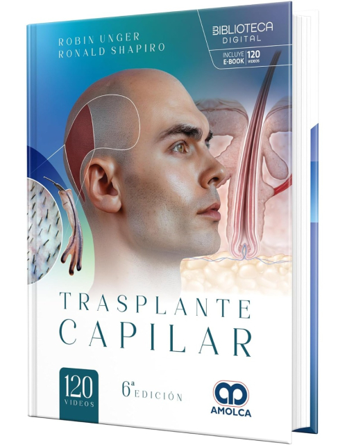 Trasplante Capilar