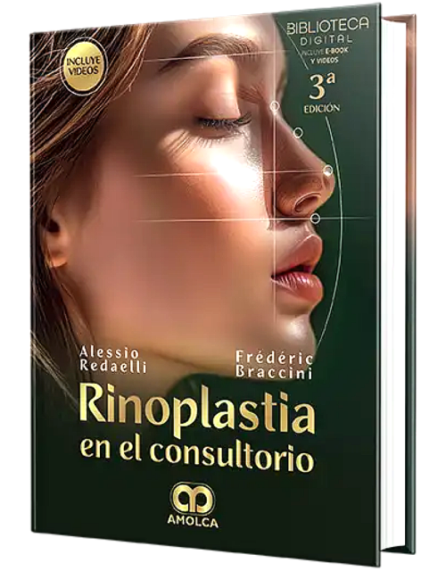 Rinoplastia en el Consultorio