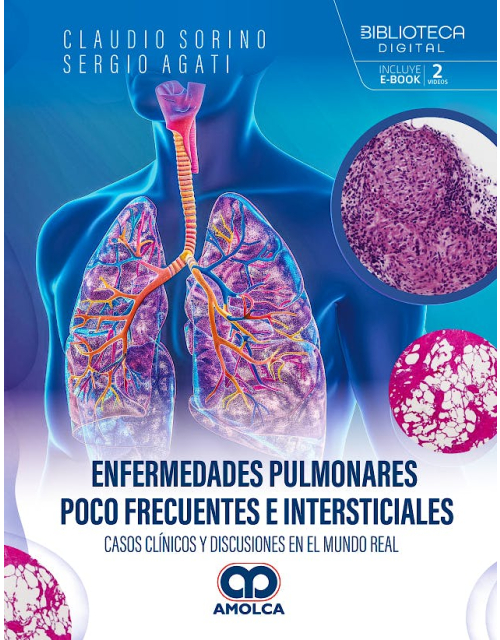 Enfermedades Pulmonares Poco Frecuentes e Intersticiales