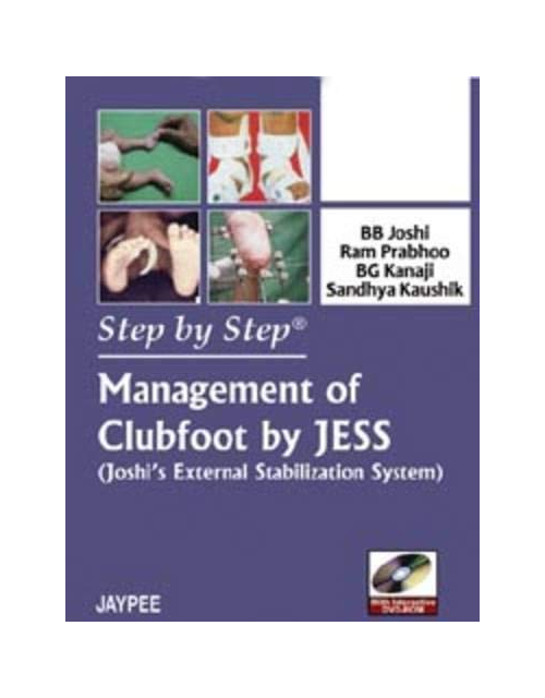 Step by Step Management of Clubfoot by Jess: Joshi's External Stabilization System
