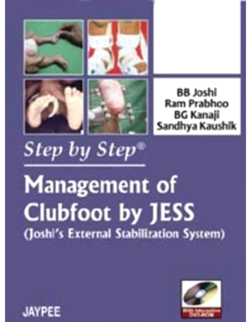 Step by Step Management of Clubfoot by Jess: Joshi's External Stabilization System
