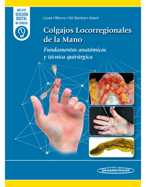 Colgajos Locorregionales de la Mano