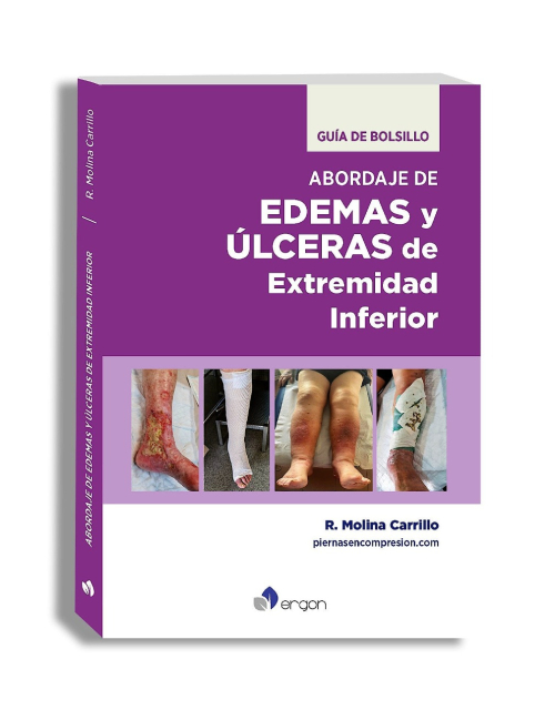 Abordaje de Edemas y Úlceras de Extremidad Inferior