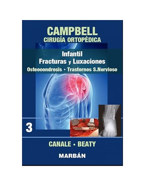 Campbell Cirugía Ortopédica, Tomo 3: Infantil. Fracturas Y Luxaciones: Osteocondrosis. Trastornos Sistema Nervioso