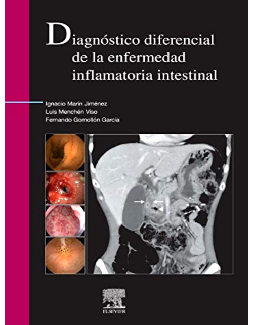 Diagnóstico diferencial de la enfermedad inflamatoria intestinal