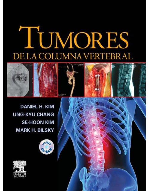 Tumores de la columna vertebral