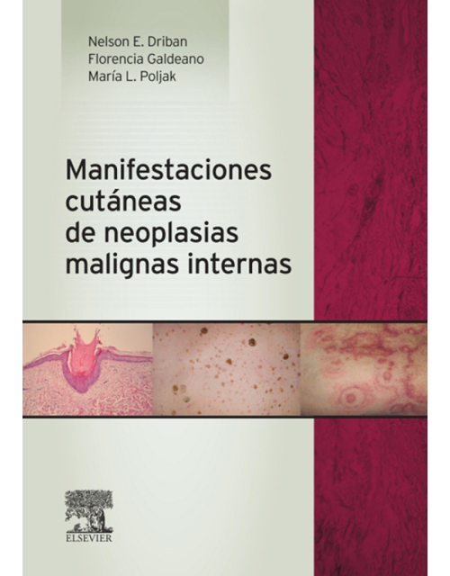 Manifestaciones Cutáneas De Neoplasias Malignas Internas