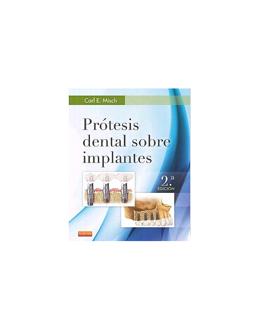 Prótesis Dental Sobre Implantes .