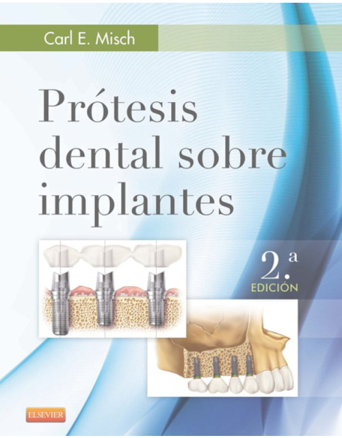 Prótesis Dental Sobre Implantes .