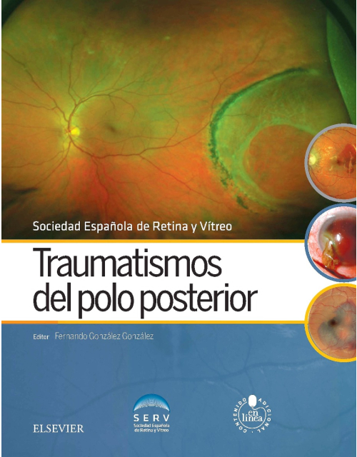 Traumatismos Del Polo Posterior + Acceso Online
