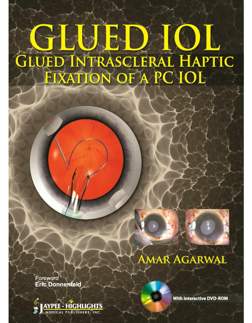 GLUED IOL: Glued Intrascleral Haptic Fixation of a PC IOL