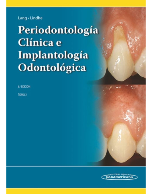 Periodontología Clínica E Implantología Odontológica, Tomo 2