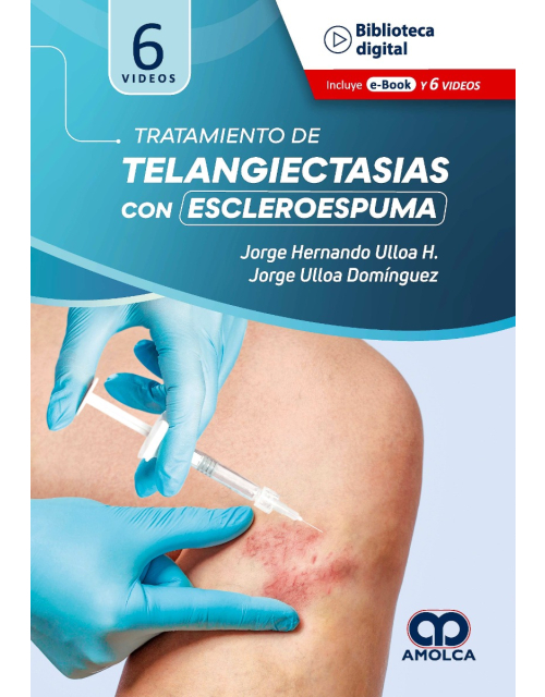 Tratamiento de Telangiectasias con Escleroespuma