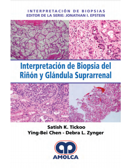 Interpretación de Biopsia del Riñón y Glándula Suprarrenal