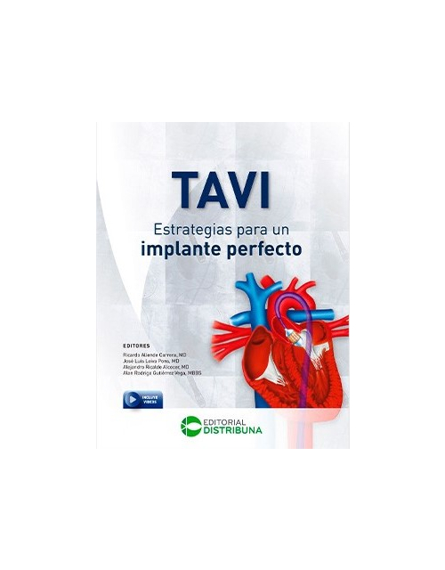 Tavi: Estrategias Para Un Implante Perfecto