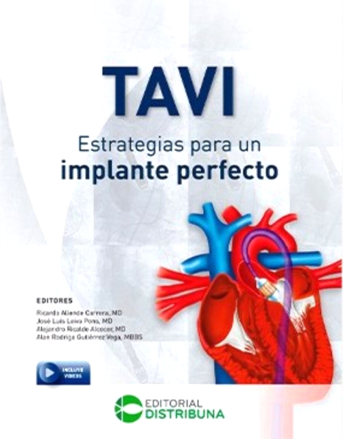 Tavi: Estrategias Para Un Implante Perfecto