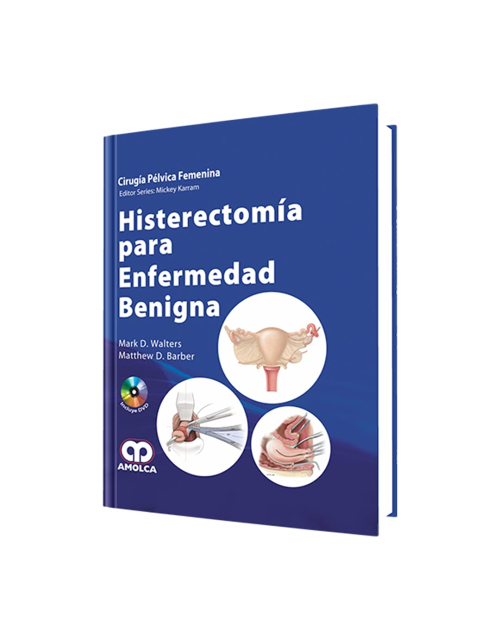 Histerectomía para Enfermedad Benigna