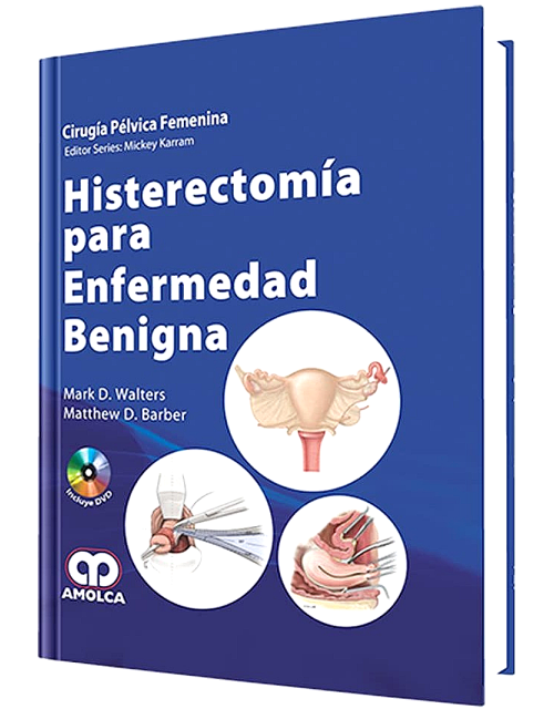 Histerectomía para Enfermedad Benigna