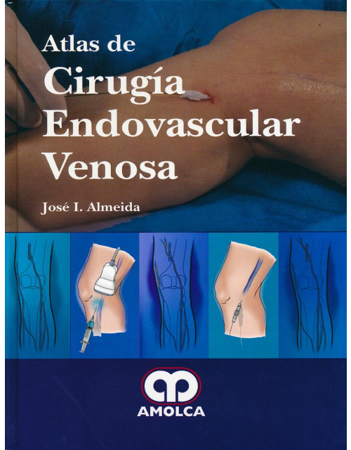 Atlas de Cirugia Endovascular Venosa