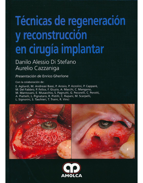 Técnicas de Regeneración y Reconstrucción en Cirugía Implantar