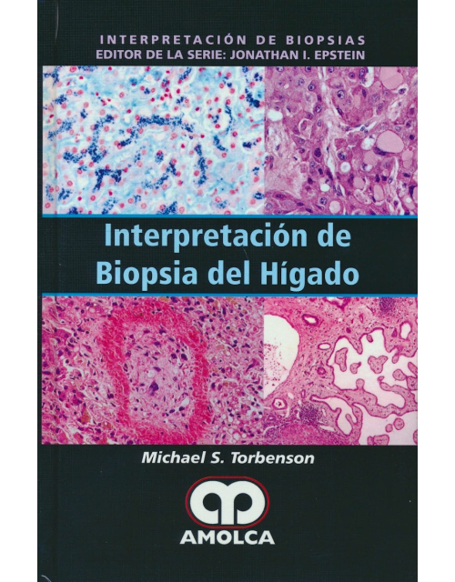 Interpretación de Biopsia del Hígado