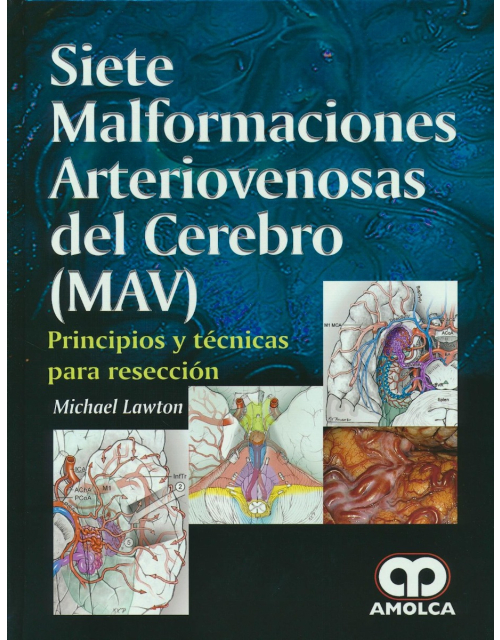 Siete Malformaciones Arteriovenosas del Cerebro (MAV)