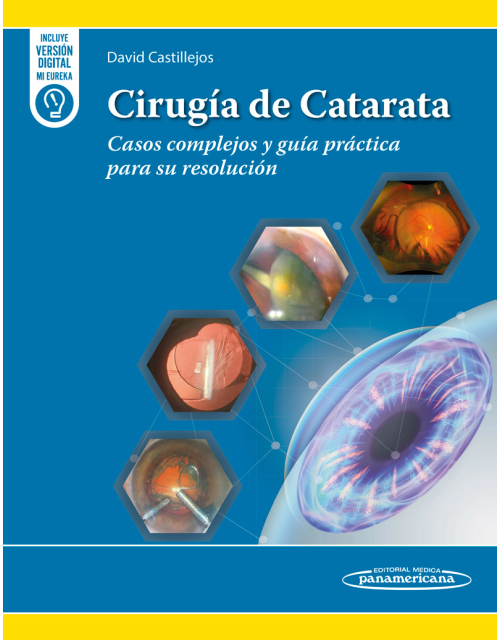 Cirug&iacute;a de Catarata