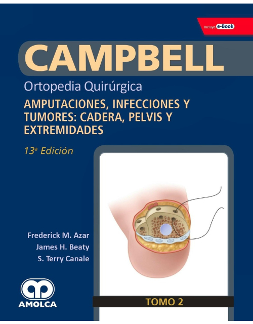 CAMPBELL Ortopedia Quirúrgica, Tomo 2: Amputaciones, Infecciones y Tumores: Cadera, Pelvis y Extremidades