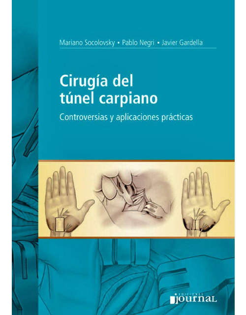 Cirugía del Túnel Carpiano