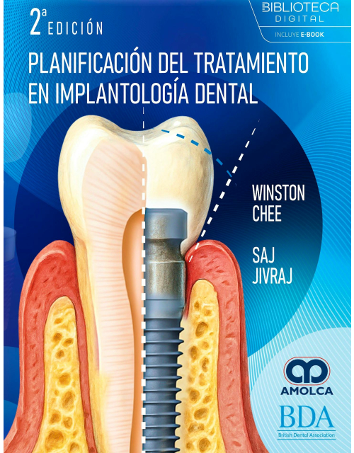 Planificación del Tratamiento en Implantología Dental