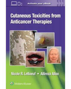 Cutaneous Reactions To Anti-Cancer Therapies
