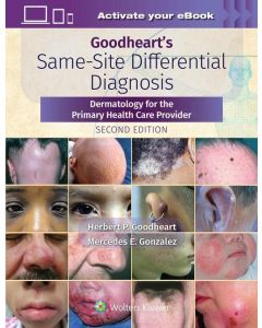 Goodheart'S Same-Site Differential Diagnosis