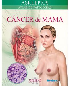 Cancer de Mama